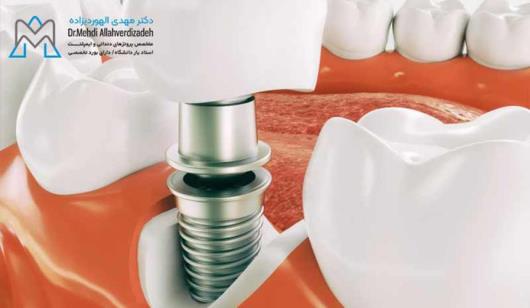 انواع ایمپلنت دندان